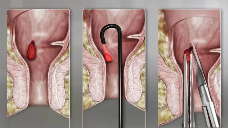 Clinical Symptoms of Hemorrhoids: