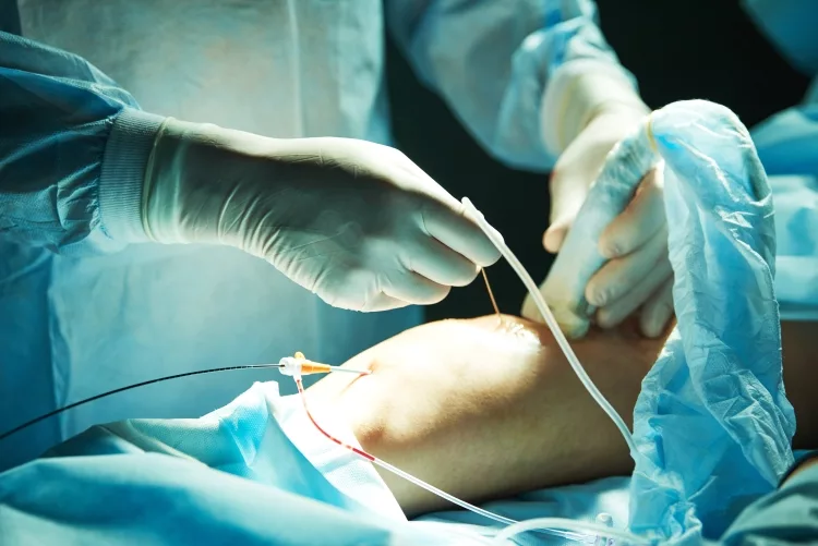 Sclerotherapy