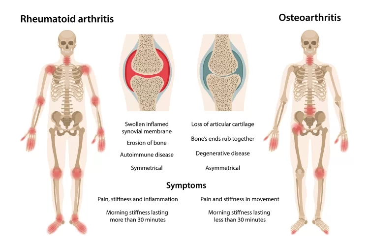 Difference between rheumatoid arthritis and osteoarthritis