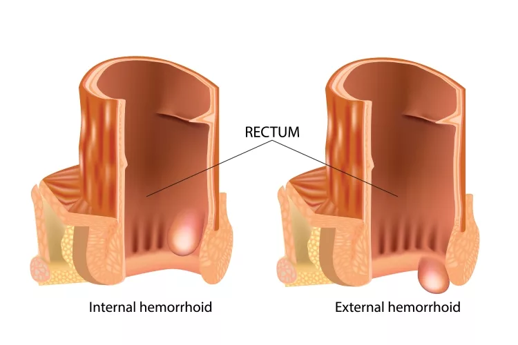 Types of Hemorrhoids. Hemorrhoids, also called piles, are vascular structures in the anal