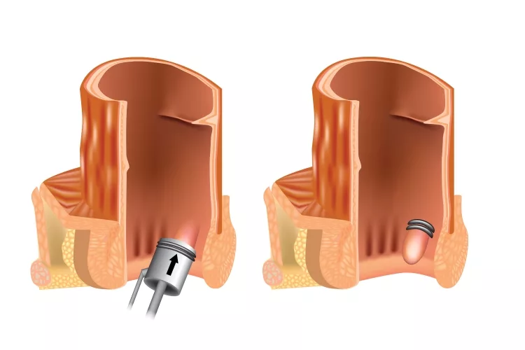 Rubber band ligation of hemorrhoid (latex ligation). RBL. Anoscope