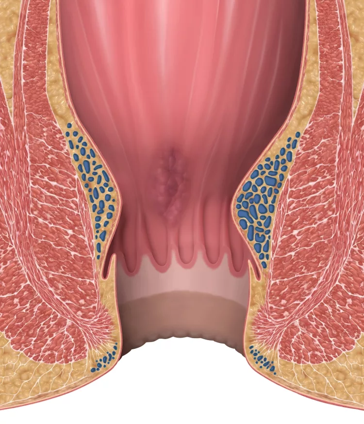 Hemorrhoids Stage 1