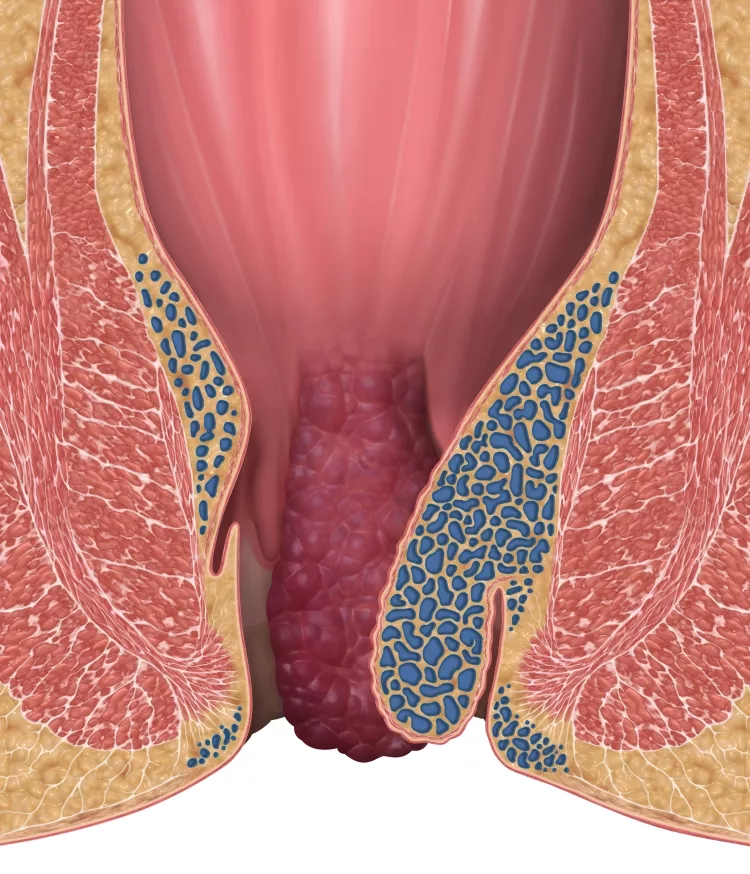 Hemorrhoids Stage 3