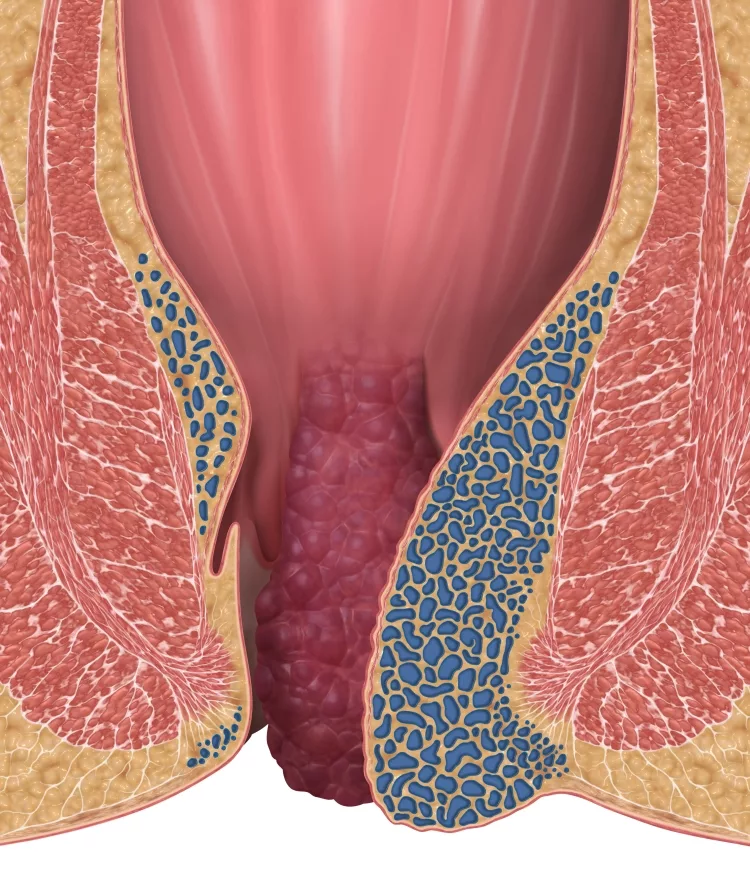 Hemorrhoids Stage 4