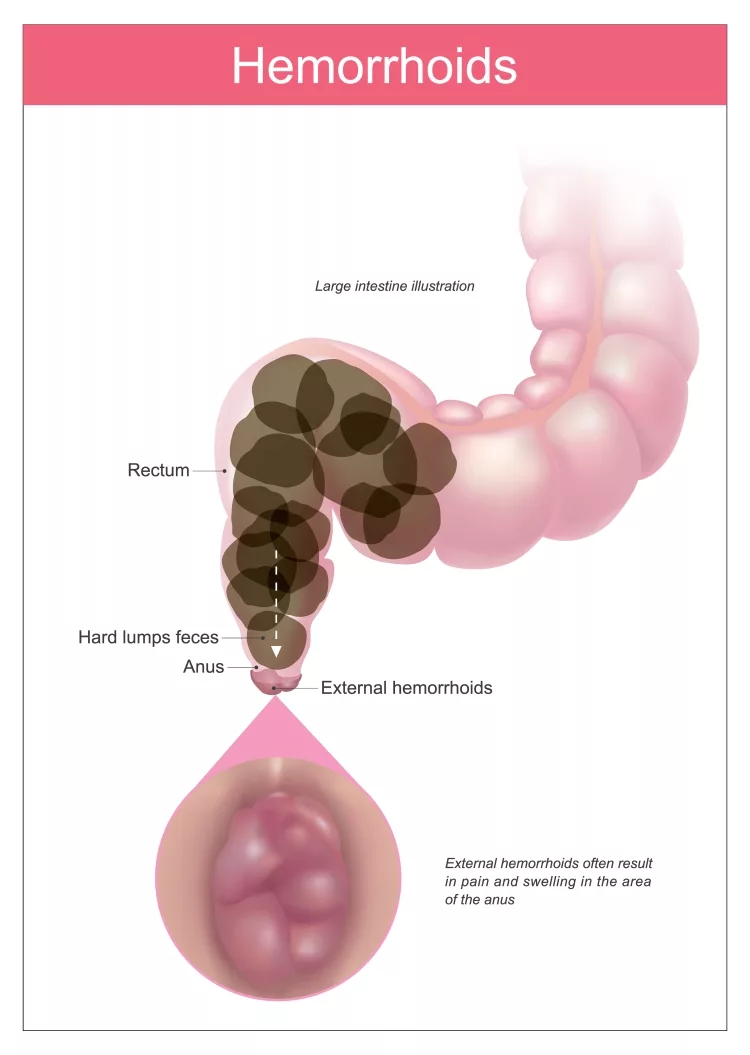 clinical photos of hemorrhoids