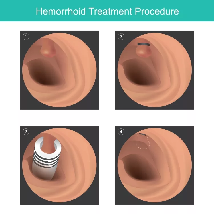 Hemorrhoid Treatment Procedure. 3D illustration for medical use about treatment hemorrhoidal by rubber banding tool