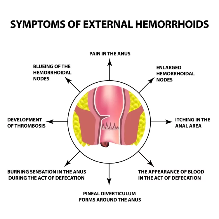 Symptoms of External Hemorrhoids