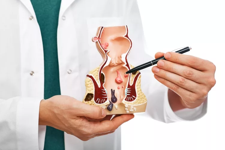 Treatment of Hemorrhoid. Proctologist pointing pen rectum pathologies on an anatomical model