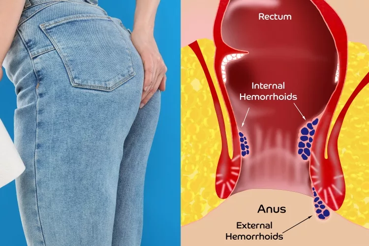 Woman suffering from internal and external hemorrhoid pain