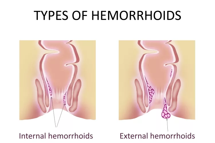 Types of Hemorrhoid: Unhealthy lower rectum with inflamed vascular structures