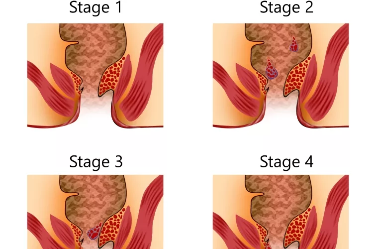 Hemorrhoid stages. Unhealthy lower rectum with inflamed vascular structures