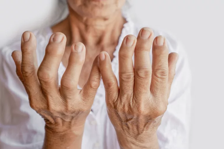Asian female patient showing hand and fingers problem of gout, joint pain