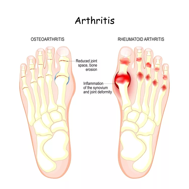 osteoarthritis, rheumatoid arthritis, and posttraumatic arthritis