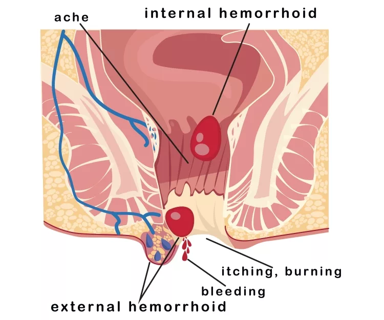 internal and external hemorrhoid node, hemorrhoid symptoms, anus, medica