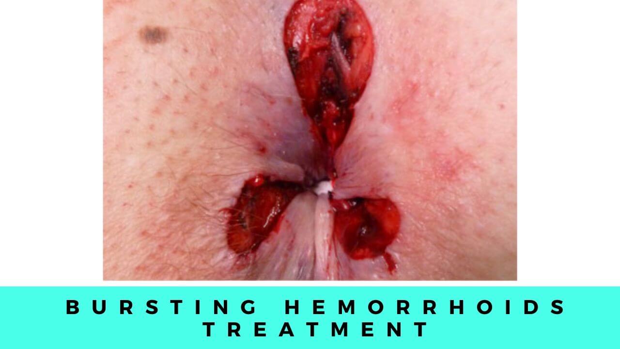 Hemorrhoids Bursting