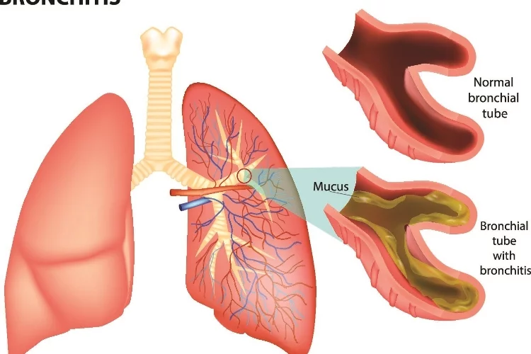 How to Cure Bronchitis Permanently: 