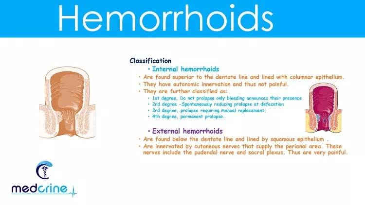 Key Difference between External and Internal Hemorrhoids