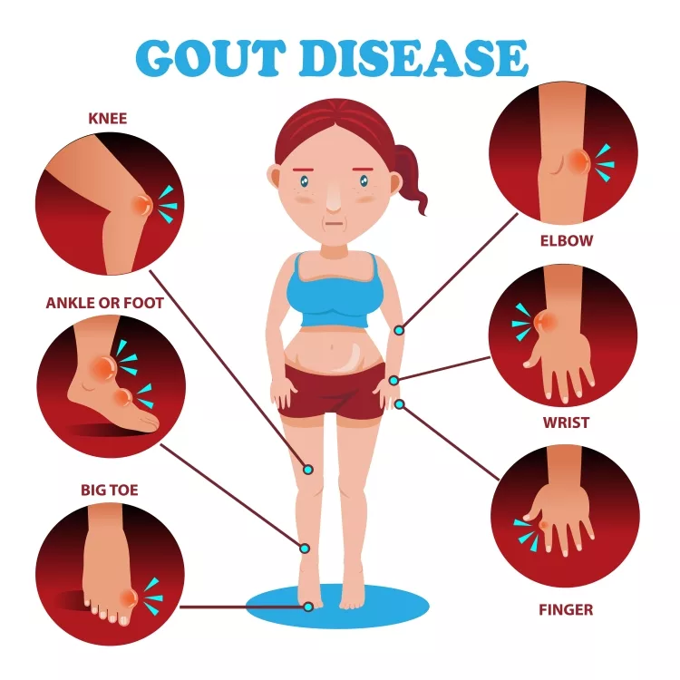 Chronic Tophaceous Gout