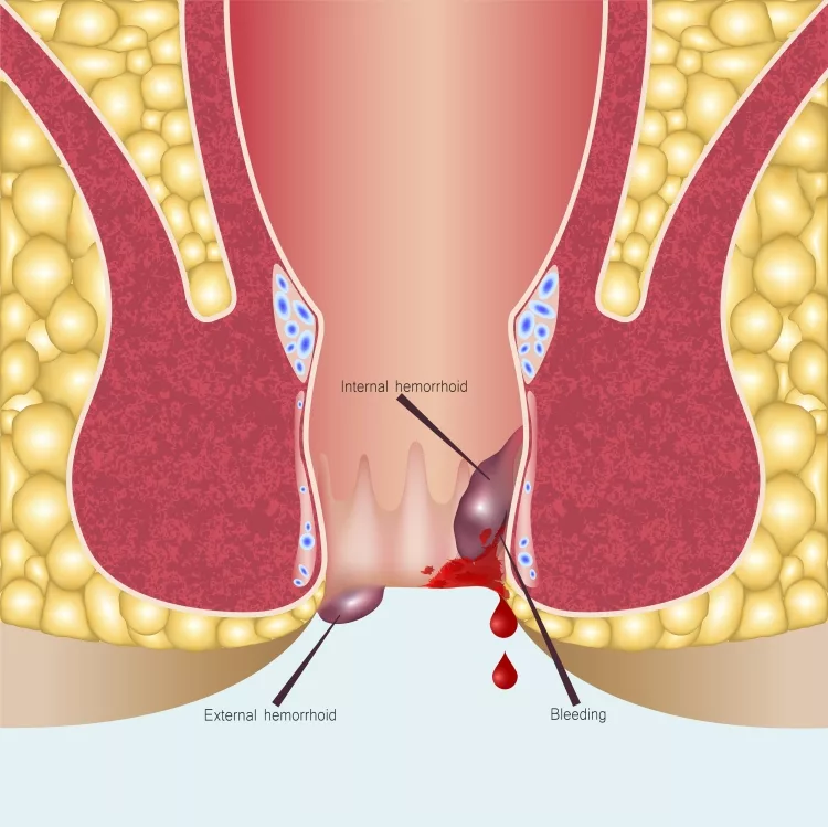 Internal hemorrhoids vs external hemorrhoids