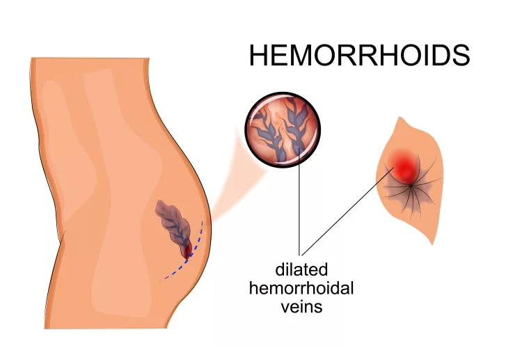 Dilated Veins Hemorrhoids