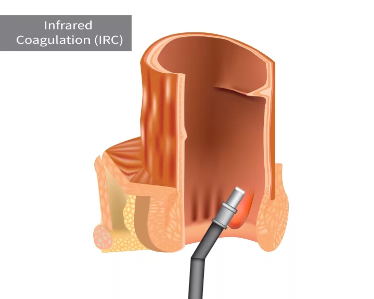 Infrared Coagulation Therapy for Hemorrhoids