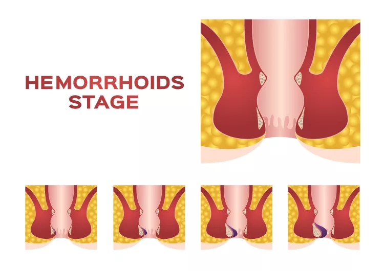 All Hemorrhoids Stage