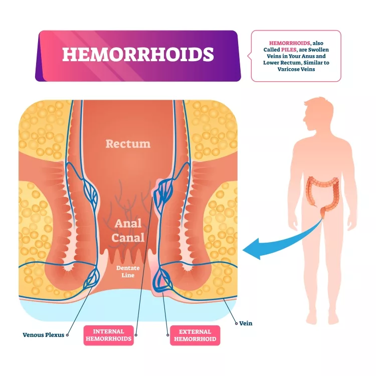 Hemorrhoids : anatomical vascular piles scheme