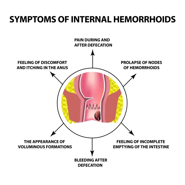 Symptoms of Internal Hemorrhoids