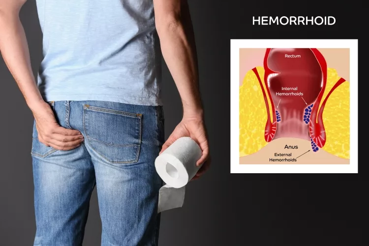 Man with toilet paper suffering from hemorrhoid pain