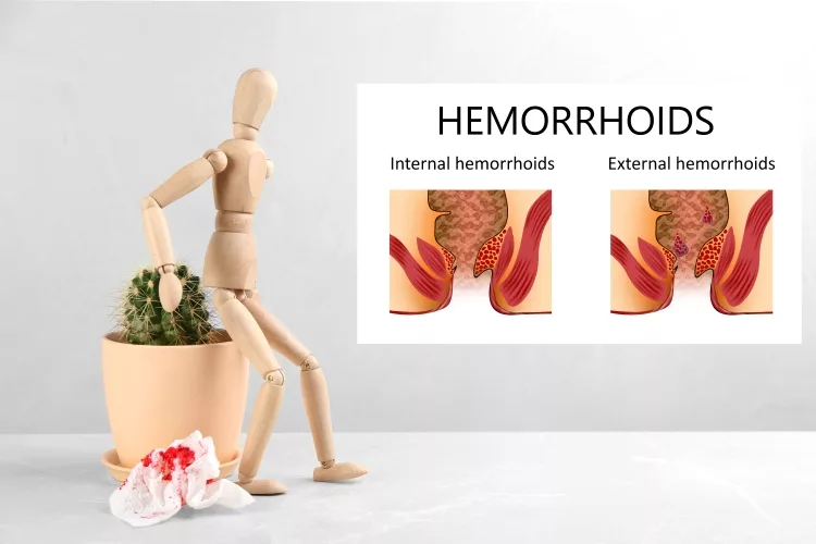 Hemorrhoids by Wooden human figure with unhealthy lower rectum