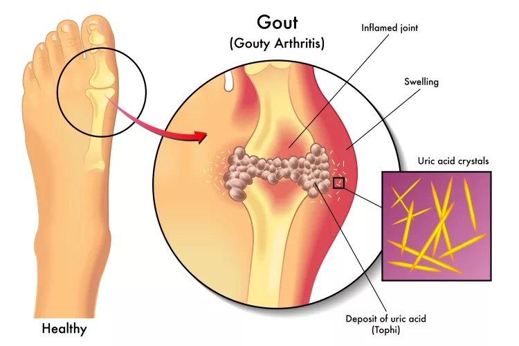 Gouty Arthritis Picture