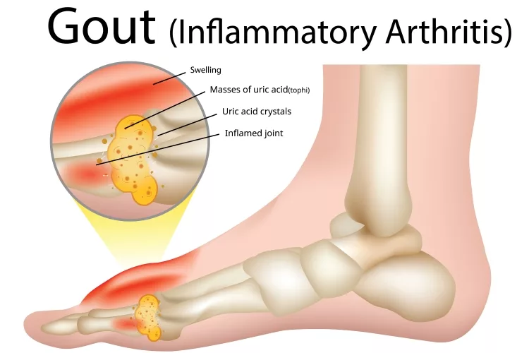 Image of Gout (Inflammatory arthritis) Gout is an intensely painful type of arthritis