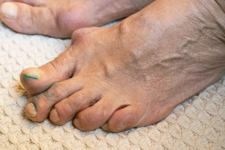 inflamed and deformed joints on the toes of middle aged lady due to arthritis or gout, close-up, selective focus