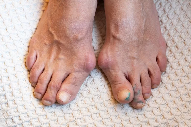 Painful gout inflammation on toe joints. Inflammation and deformity of the toes