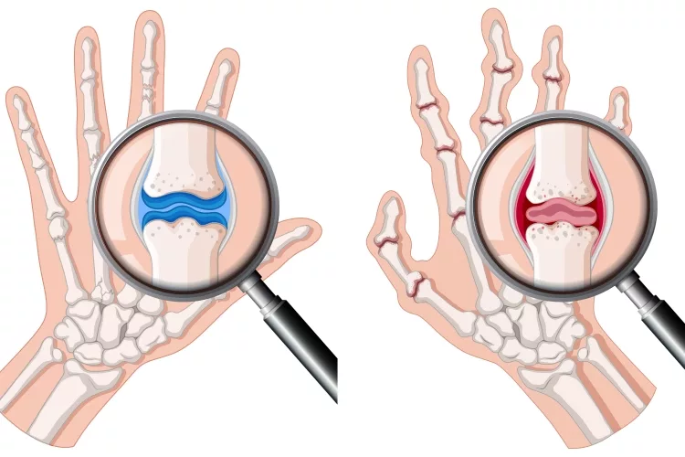 A human hand with rheumatoid arthritis