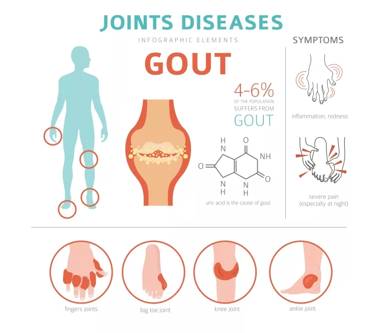 Infographic of Gout symptoms, treatment, and Icons