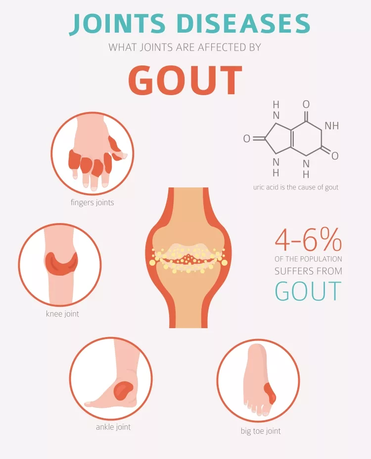 Picture of Joints diseases and Gout symptoms