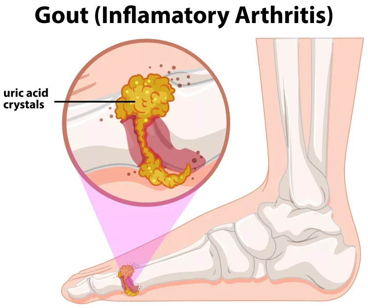 A Medical Human Anatomy Gout