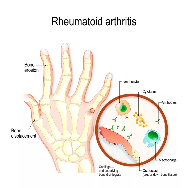 Rheumatoid Arthritis (RA) is an auto immune disease and inflammatory type of arthritis
