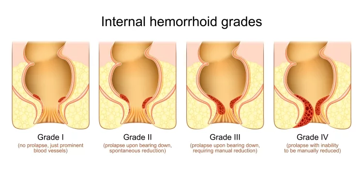 hemorrhoid grades. Stage of Internal piles