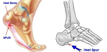 Heel Spur Causing Foot Pain (Courtesy of Heel-That-Pain.com)