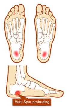 Diagram Showing Heel Spur For Foot Pain (Courtesy of heal-That-Pain.com)