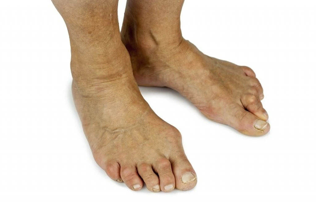 Bunions Need To Be Treated