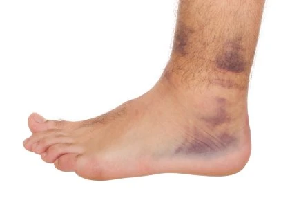 Ankle Sprain Causes, Support and Treatments
