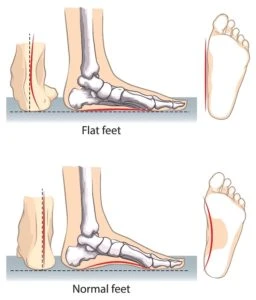 Treating Flat Feet - Comparison Chart
