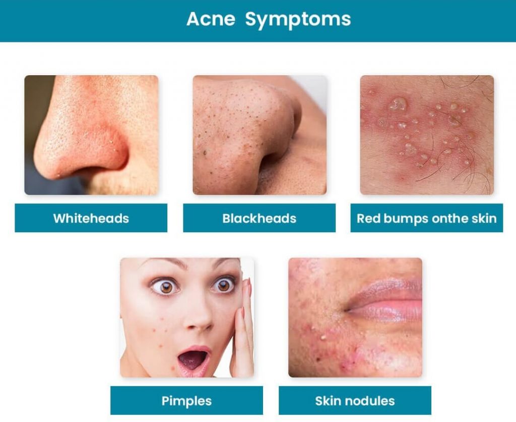 Signs and Symptoms of Acne