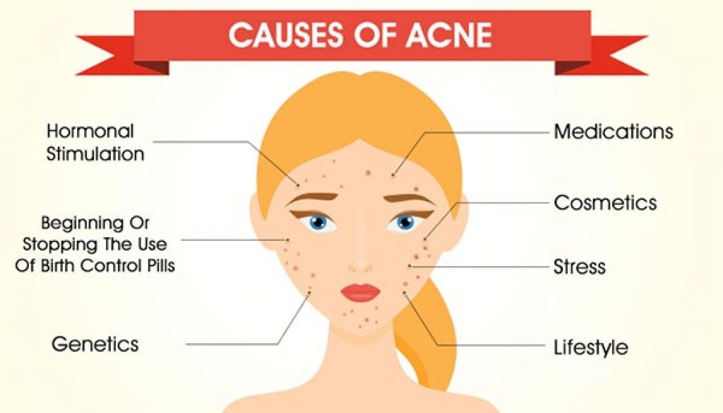 What Causes Acne? 
