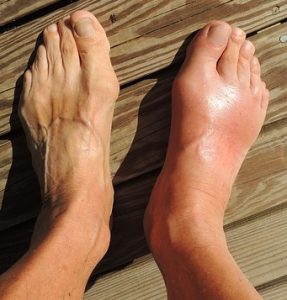 List Of Foods To Avoid With Gout