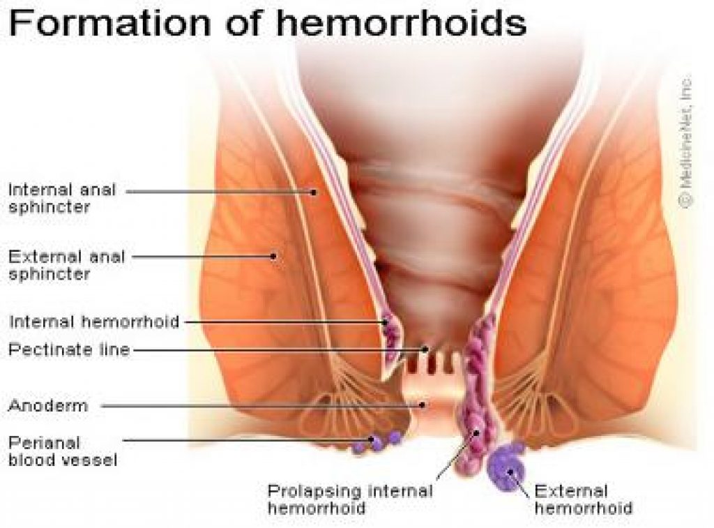 rizikový faktor hemoroidů