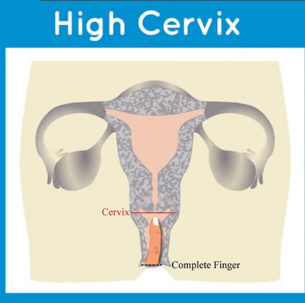 High Cervix 